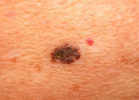 Stage 1 early stage melanoma images | Symptoms and pictures