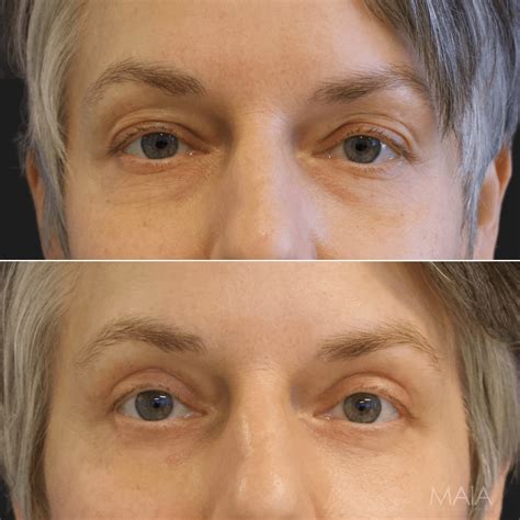 Washington DC Lower Blepharoplasty Under Eye Bag Removal Before And