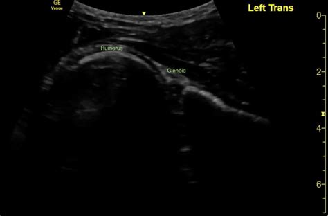 Shoulder Dislocation On Ultrasound — Cook County Emergency Medicine Residency