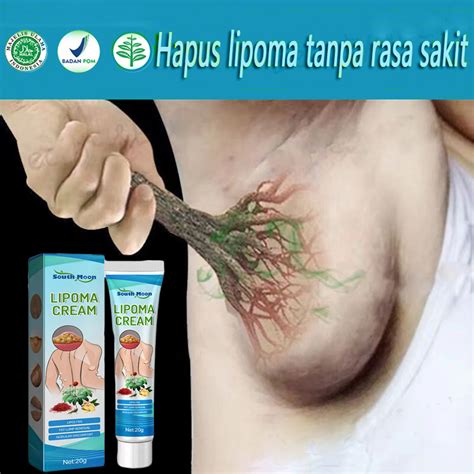 Ubat Benjolan Lipoma Removal Cream South Moon Benjolan Swelling