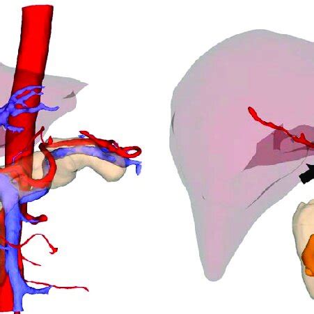 Vascular abnormalities---the branches of SMA replace the right hepatic... | Download Scientific ...