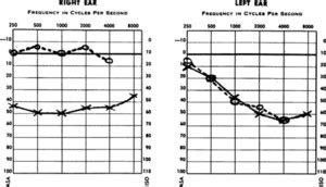 Audiological Aspects Of The Diagnosis Of Acoustic Neuromas In Journal