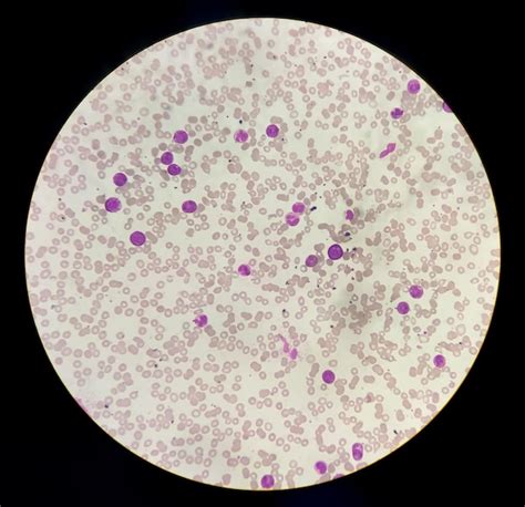 Células de leucemia mieloide crónica o lmc analizadas al microscopio