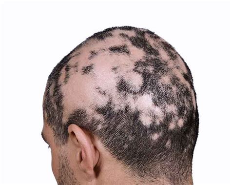 Alopecia Areata Treatment Symptoms Risk Factors Causes Types