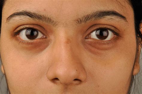 Eye Swelling Under The Eye