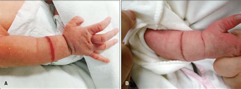 A Linear Circumferential Erythematous And Vesicular Band On The Download Scientific Diagram