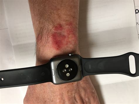 Apple Watch Burn Or Rash Apple Community