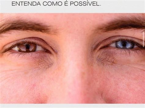 Pessoas Olhos De Cores Diferentes Entenda Como Poss Vel Blog