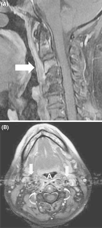 A Contrast Enhanced Sagittal T1 Weighted Mri Of The Cervical Spine