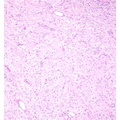 Gross Specimen Of Partial Cystectomy Showing A Diffuse Infiltrative