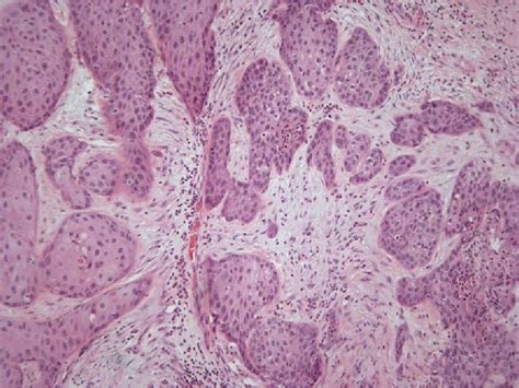 Figure 1 From Squamous Cell Carcinoma And Osteosarcoma Arising From A