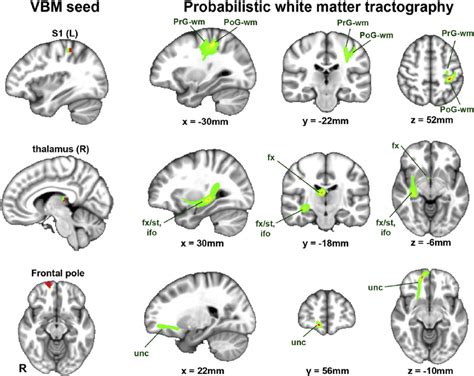 Signi Fi Cant Clusters From The VBM Analysis Served As Seeds To