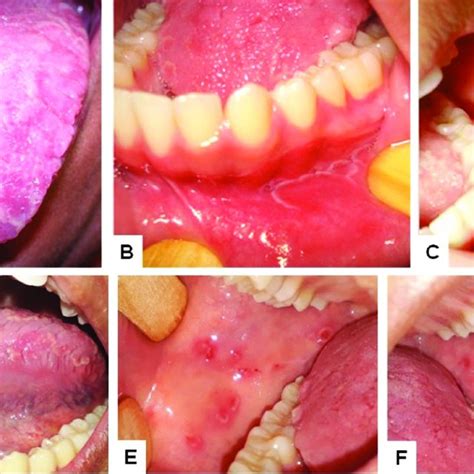 Case 3. Geographic and fissured tongue (A) and reddish patches ...