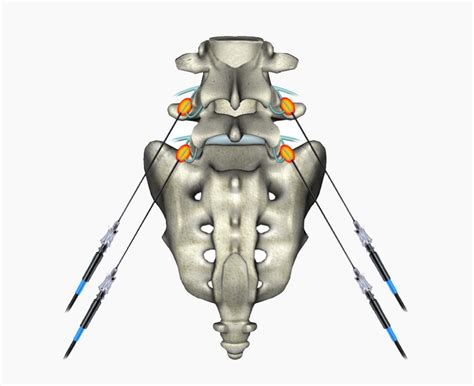 Facet Joint Neurotomies Rhizotomies Painscience