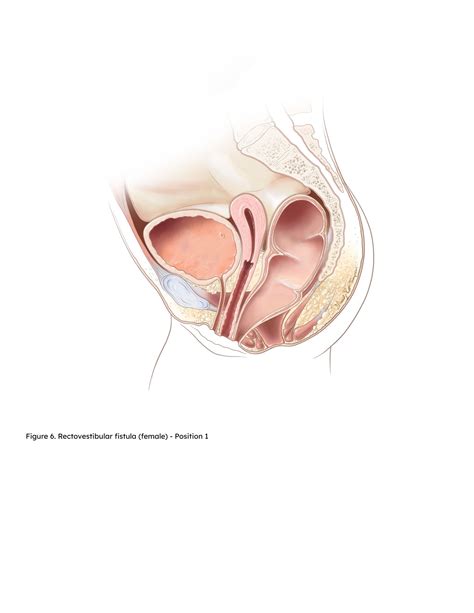 ANORECTAL MALFORMATIONS