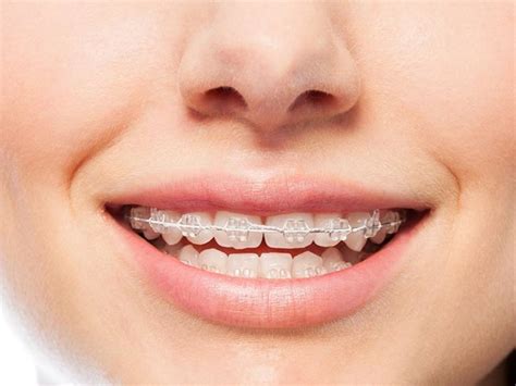 Metal Bracestraditional Braces Clear Choice Orthodontist