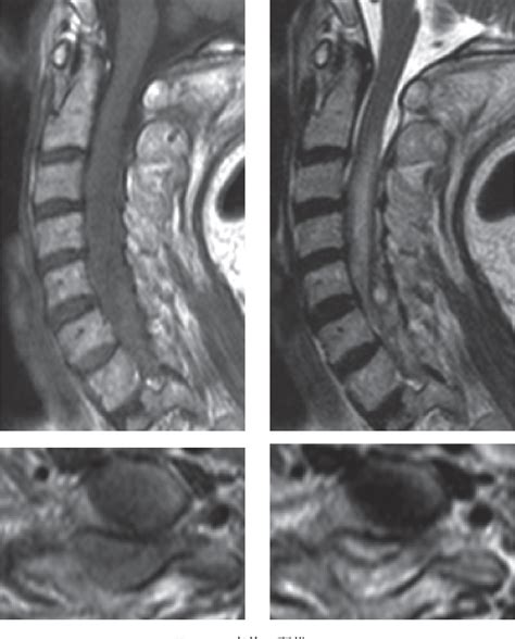 Figure 1 From A Case Of Cervical Spinal Epidural Hematoma Presenting