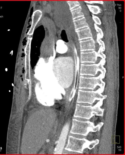 Trauma With Sternal Fracture And Air In The Chest Wall Trauma Case