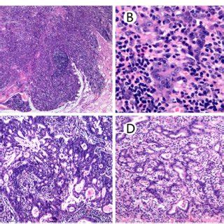 Histopathologic Characteristics Of Epstein Barr Virus Associated Early