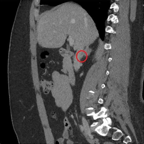 Sagittal 3d Reconstruction Of Ct Scan In Venous Phase In Particular Download Scientific