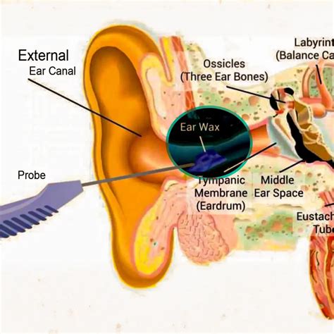 Ear Wax Removal Hills Audiology