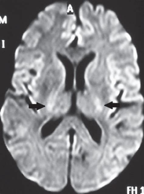 Mri Brain Flair Showing Hyperintense Foci In Subcortical And