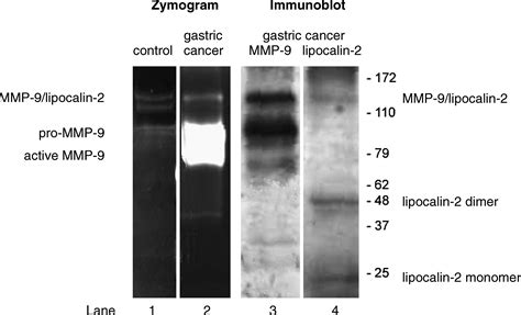 Clinical Evidence For A Protective Role Of Lipocalin Against Mmp