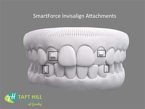 Invisalign Attachments Explained: how they work to help with your Treatment - Taft Hill Orthodontics