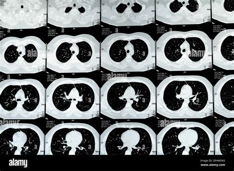 Multi Slice CT Scan Of The Chest Showing Normal Study Normal