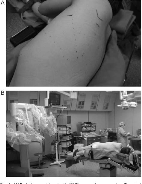 Figure From Robot Assisted Resection Of Pulmonary Sequestrations