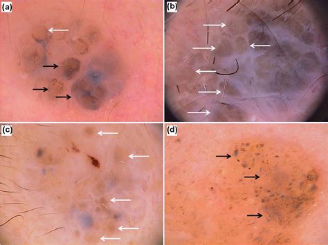 Figure 1 From High Magnification Digital Dermoscopy Of Basal Cell