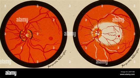 . Medical diagnosis for the student and practitioner. tis.) Fundus ...