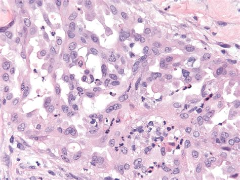 Pathology Outlines Low Grade Serous Carcinoma