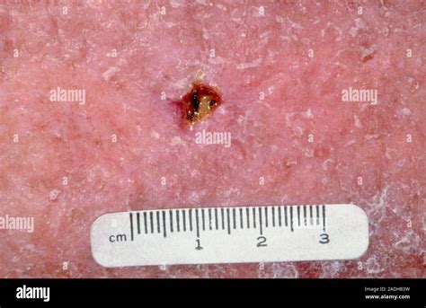 Carcinoma De Células Escamosas Primer Plano De Un Carcinoma De Células