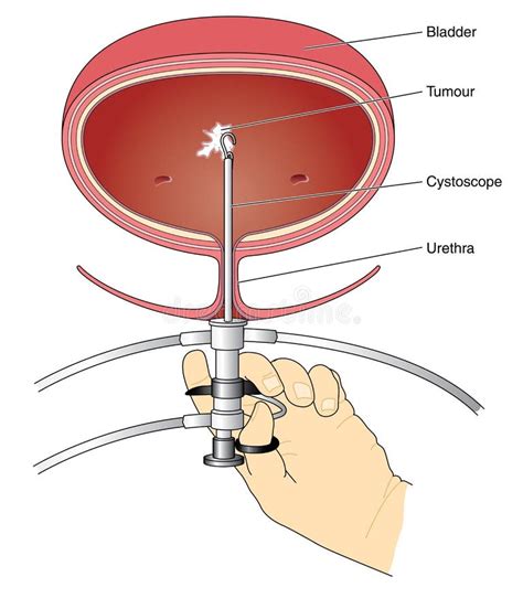 Cystoscopy Stock Illustrations 121 Cystoscopy Stock Illustrations