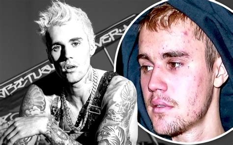 Justin bieber Speaks About His Incurable Lyme Disease & Its Serious ...