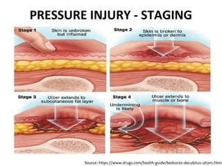 pressure injury