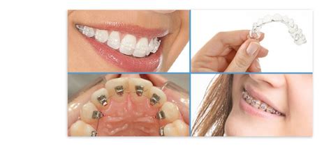 Ortodoncia Barcelona Aguilar Dental Salut V Clinica Aguilar Dental