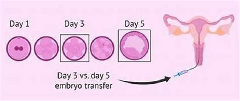 Fresh Vs Frozen Embryo Transfer Understanding Your Options In Ivf