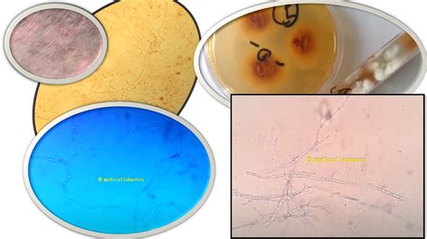 Trichophyton Archives - Medical Notes