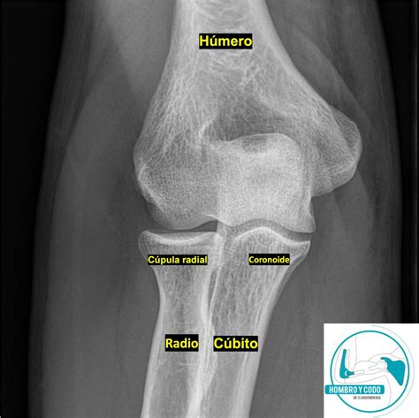 Radiograf A Del Codo