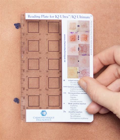 Skin Patch Test Reading Hk Johnson Group