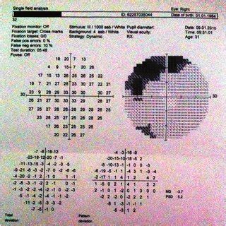 (PDF) Optic Neuritis Presenting With Altitudinal Visual Field Defect in ...