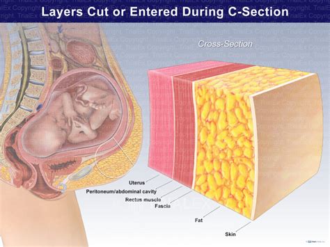 Caesarean Section Indications Classification Teachmeobgyn Off