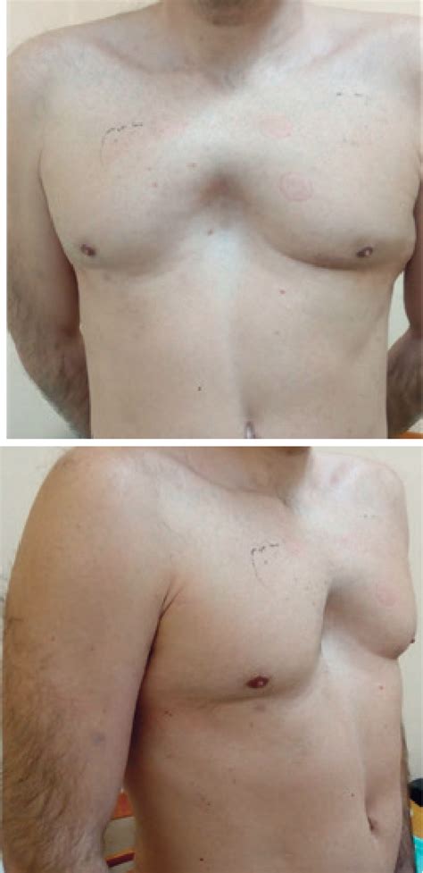 Figure 1 From A CASE OF LATE DIAGNOSIS OF MARFAN SYNDROME Semantic