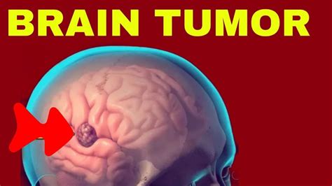 6 Signs Of BRAIN TUMOR YouTube