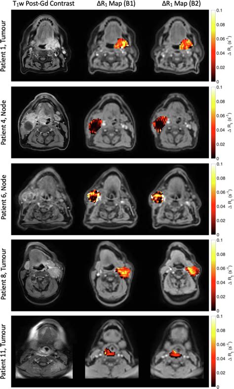 First In Human Technique Translation Of Oxygen Enhanced MRI To An MR