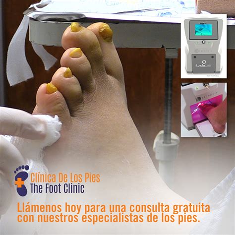 Laser Nail Fungus - The Foot Clinic Santa Ana