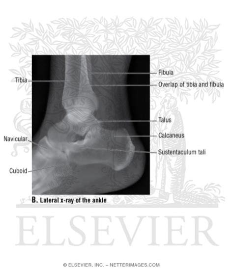 Lateral X-Ray of the Ankle