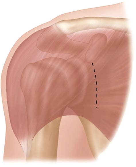 The Outcomes And Surgical Techniques Of The Latarjet Procedure